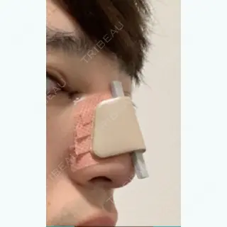 1日目の経過画像（2枚目）