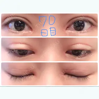70日目の経過画像（1枚目）