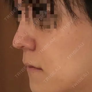 32日目の経過画像（3枚目）