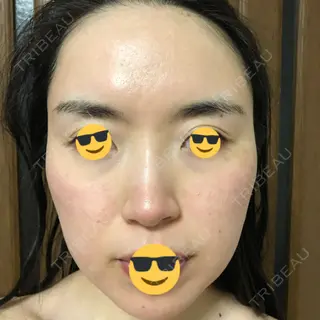 0日目の経過画像（1枚目）