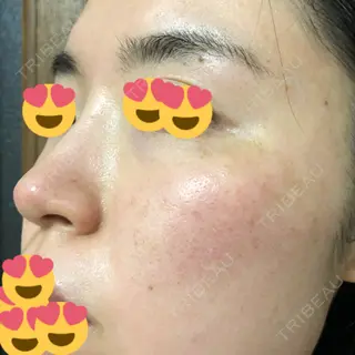 0日目の経過画像（3枚目）