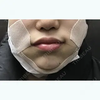 0日目の経過画像（1枚目）