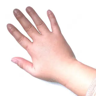 4日目の経過画像（3枚目）