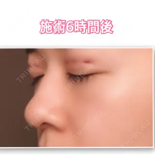 0日目の経過画像（2枚目）