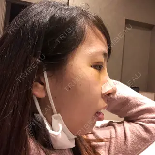 5日目の経過画像（3枚目）