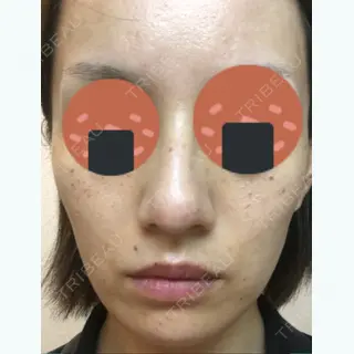 0日目の経過画像（1枚目）