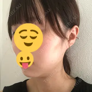 0日目の経過画像（2枚目）
