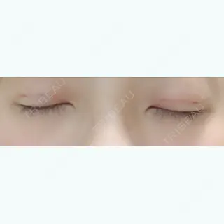 0日目の経過画像（2枚目）