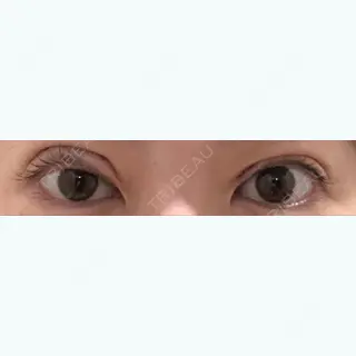 0日目の経過画像（1枚目）