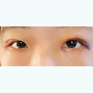 3日目の経過画像（1枚目）