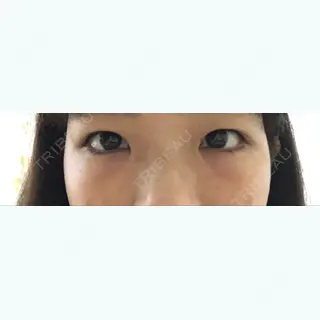 1日目の経過画像（1枚目）