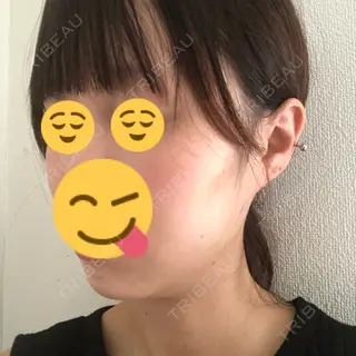 3日目の経過画像（2枚目）