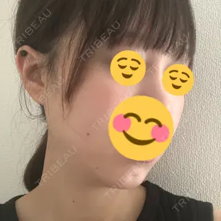 3日目の経過画像（3枚目）