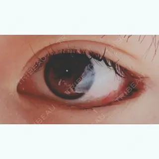 12日目の経過画像（2枚目）