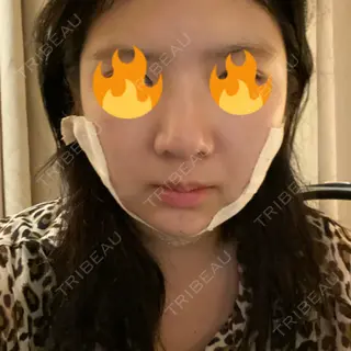 0日目の経過画像（1枚目）