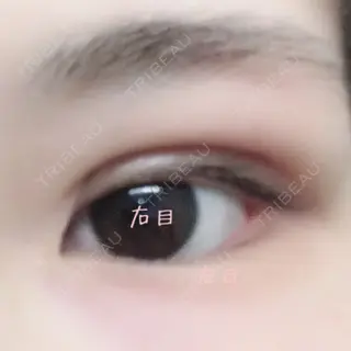 0日目の経過画像（2枚目）
