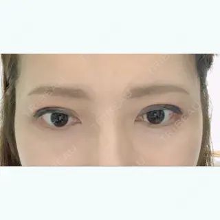 27日目の経過画像（2枚目）
