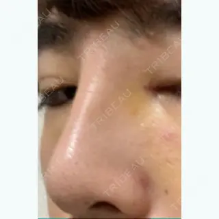 6日目の経過画像（2枚目）