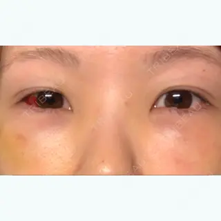 6日目の経過画像（1枚目）