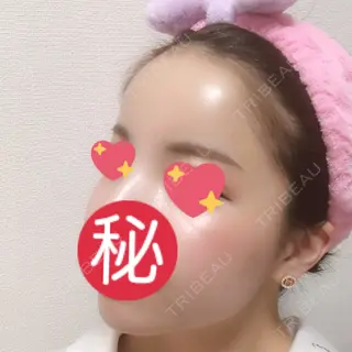 9日目の経過画像（3枚目）