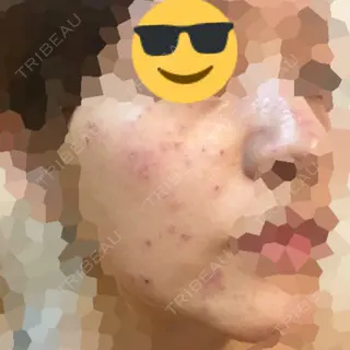 0日目の経過画像（1枚目）