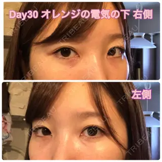 30日目の経過画像（2枚目）