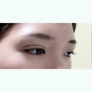 25日目の経過画像（2枚目）