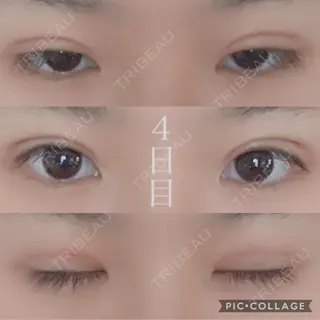 3日目の経過画像（1枚目）