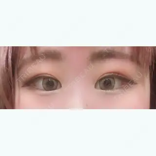 27日目の経過画像（1枚目）