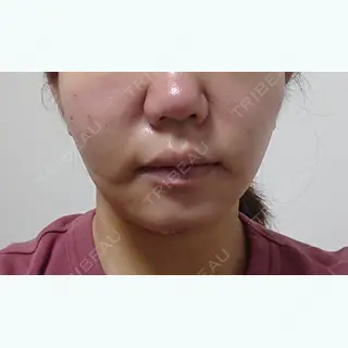 2日目の経過画像（1枚目）