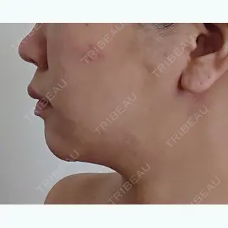 3日目の経過画像（3枚目）