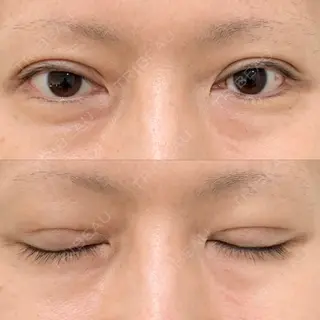 30日目の経過画像（1枚目）