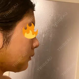5日目の経過画像（3枚目）