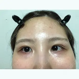 14日目の経過画像（1枚目）