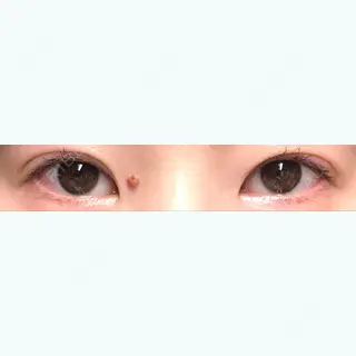 72日目の経過画像（1枚目）