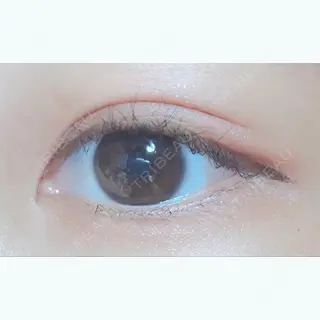 141日目の経過画像（2枚目）