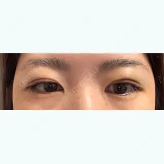 3日目の経過画像（2枚目）
