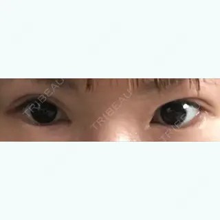 58日目の経過画像（1枚目）