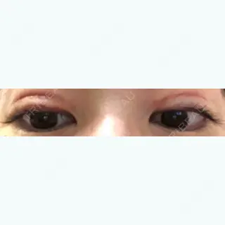 8日目の経過画像（3枚目）