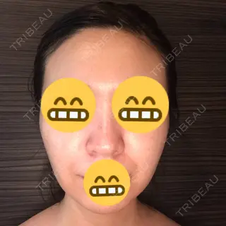 20日目の経過画像（1枚目）