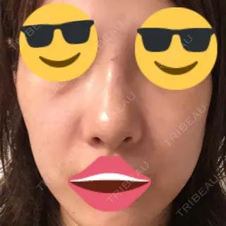 0日目の経過画像（1枚目）