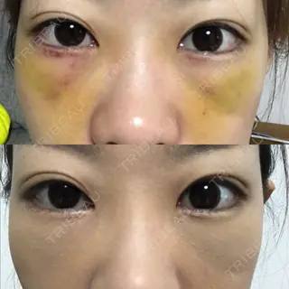 5日目の経過画像（1枚目）