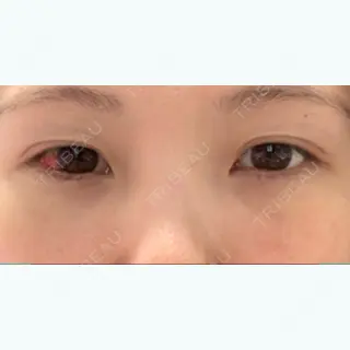 11日目の経過画像（1枚目）