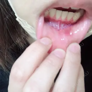 2日目の経過画像（3枚目）