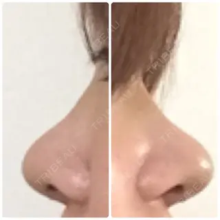 6日目の経過画像（2枚目）