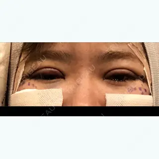0日目の経過画像（1枚目）