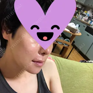 30日目の経過画像（2枚目）
