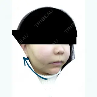 12日目の経過画像（1枚目）