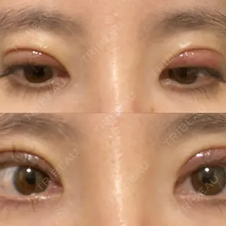 6日目の経過画像（1枚目）