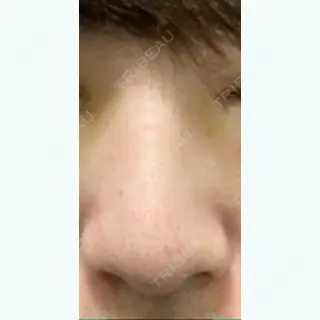 13日目の経過画像（1枚目）